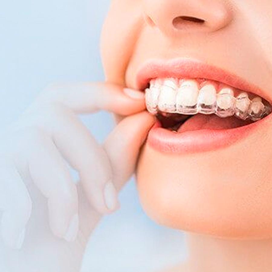 Invisalign® dental provider in Langhorne PA | Cap Dental